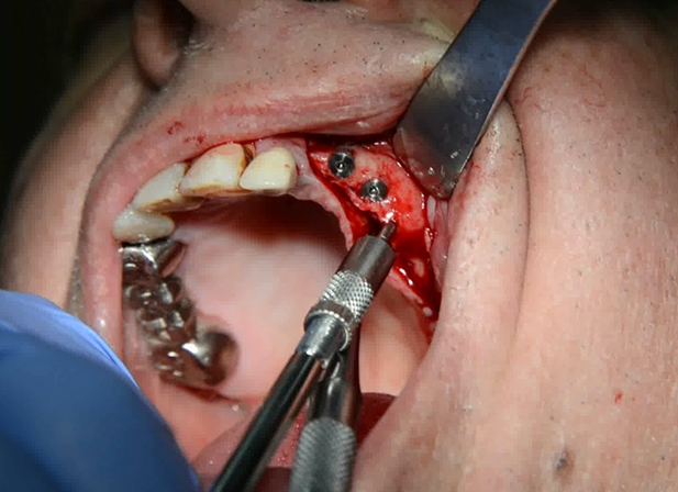 Osteotom, DIVA Technology, Upheal Dental, Sinus Lift