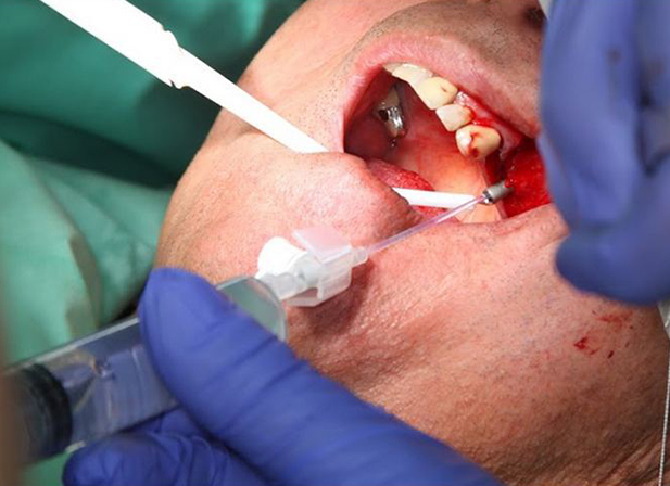DIVA Technology, Upheal Dental, Sinus Lift